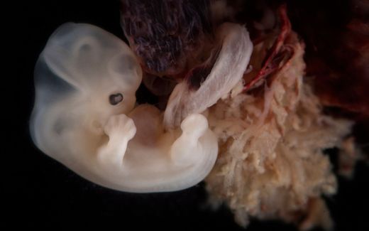 Embryo at a gestation of 6 weeks. Photo Wikimedia Commons, lunar caustic