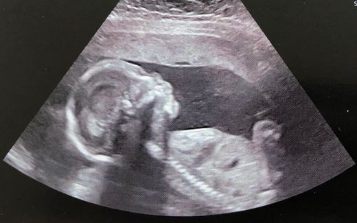 An ultrasound of an unborn baby. Photo Facebook, Føroya Pro Vita